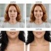 Antes e depois de drenagem facial e contorno da mandíbula